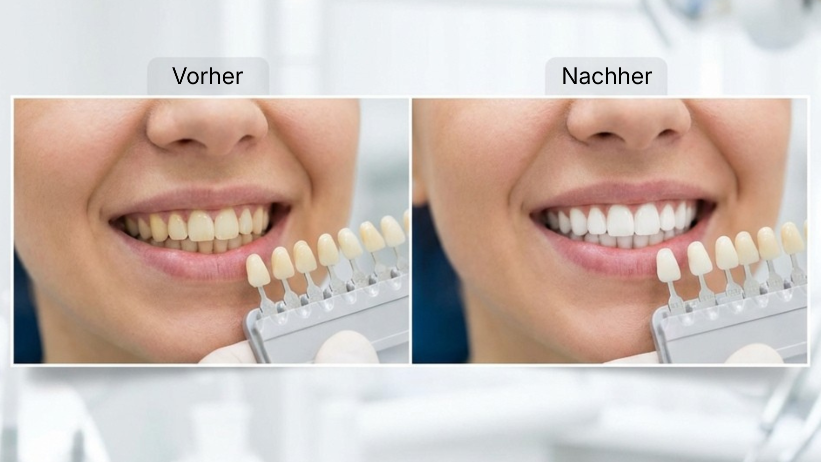 Professionelles Bleaching Dietzenbach – Zahnaufhellung beim Zahnarzt